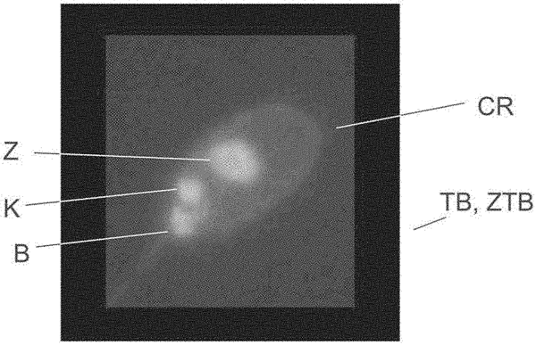 Method For Detecting A Binding Of Antibodies From A Patient Sample To 